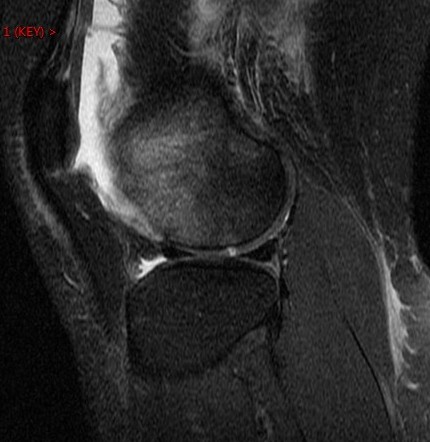 Figure 4 for case Patellar dislocation